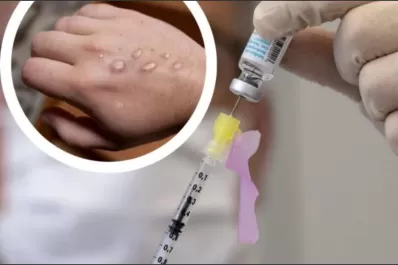 Viruela del mono: empezarán a distribuir vacunas contra la enfermedad en América latina