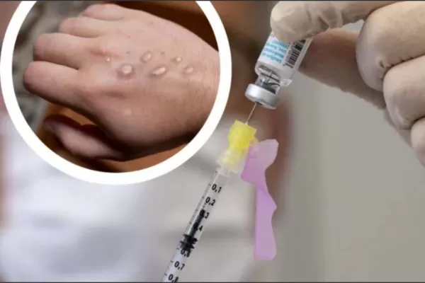 Viruela del mono: empezarán a distribuir vacunas contra la enfermedad en América latina