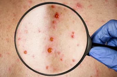 Viruela de mono: ¿qué hacer cuando aparecen los síntomas?
