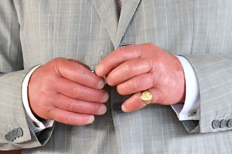 “Dedos de salchicha”: Cuál es el particular problema que afecta al rey Carlos III