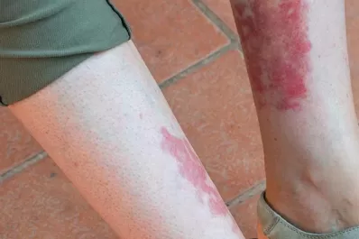 Especialista tucumana explica que son las Vasculitis y cómo reconocerlas