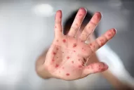 Viruela del mono en Tucumán: cuáles son los síntomas y cómo prevenir la enfermedad