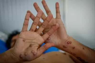 Viruela del mono en Tucumán: “Es una situación que esperábamos”, dijo Medina Ruiz