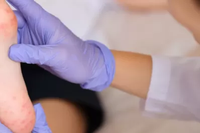 Viruela del mono: porqué aseguran que es importante asignarle otro nombre a la enfermedady cuáles son las propuestas más firmes