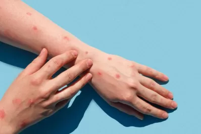 La viruela del mono y el aumento de casos: ¿influyen los antecedentes de viajes al exterior?