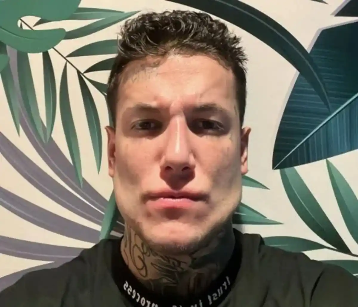 SE OPERÓ LA MANDÍBULA. Así quedó Alex Caniggia.