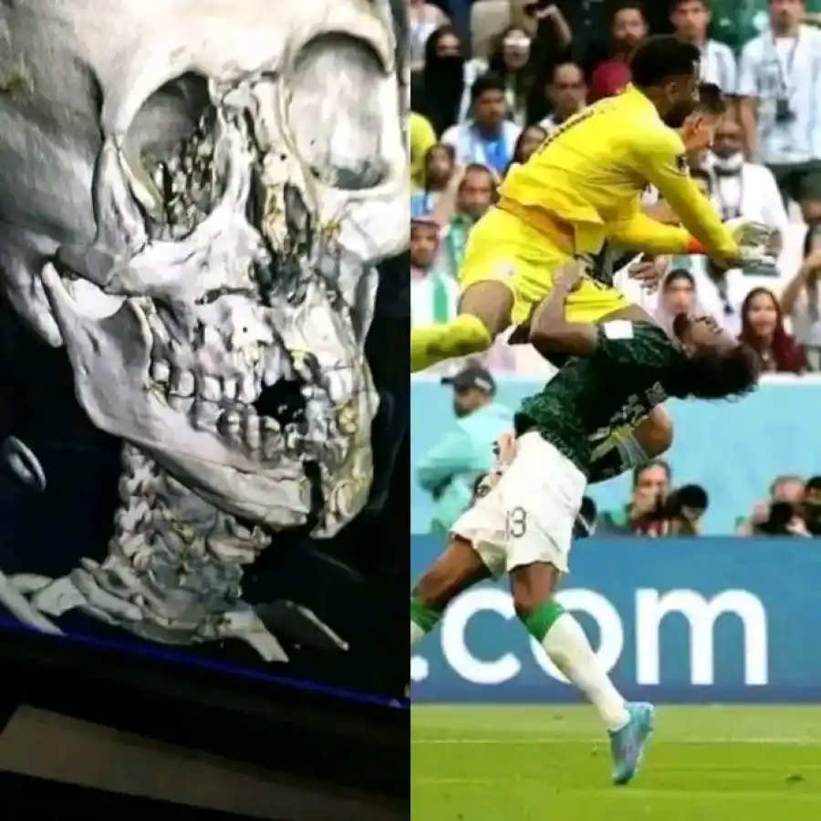 Mundial de Qatar: las impactantes secuelas que le quedaron al jugador de Arabia Saudita tras el choque con su arquero