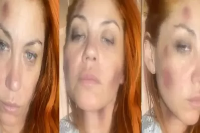 Con la cara golpeada, Lourdes de Bandana acusó a su ex pareja por violencia de género