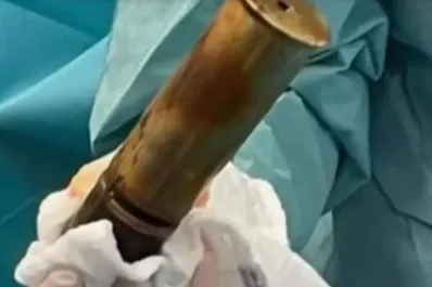 Francia: un hombre llegó al hospital con una bomba de la Primera Guerra Mundial en el recto