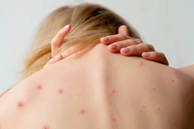 Confirman la segunda muerte por viruela del mono en Argentina y 1.025 contagios