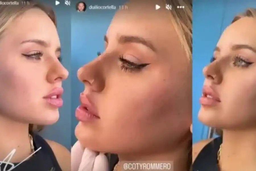 Coti de Gran Hermano se hizo un retoque estético y lo mostró en sus redes