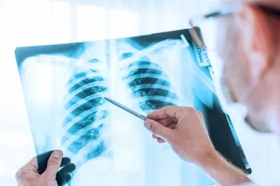 Cómo resolver el diagnóstico tardío en casos de cáncer de pulmón