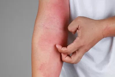 La importancia de un diagnóstico a tiempo en los casos de dermatitis atópica