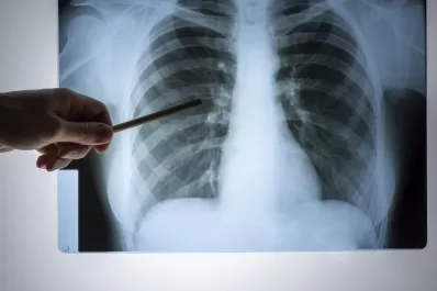 Instan al ministro de Salud a informar en detalle sobre el nuevo brote de neumonía en Tucumán