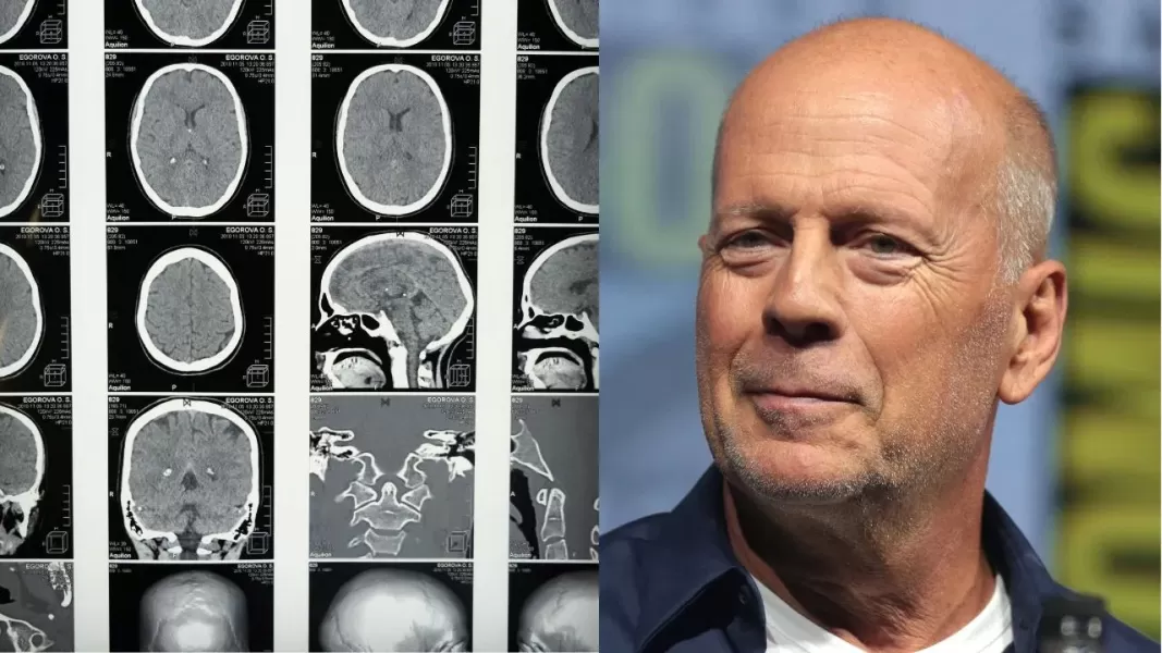 Demencia frontotemporal: cuáles son los principales síntomas de la enfermedad que padece Bruce Willis