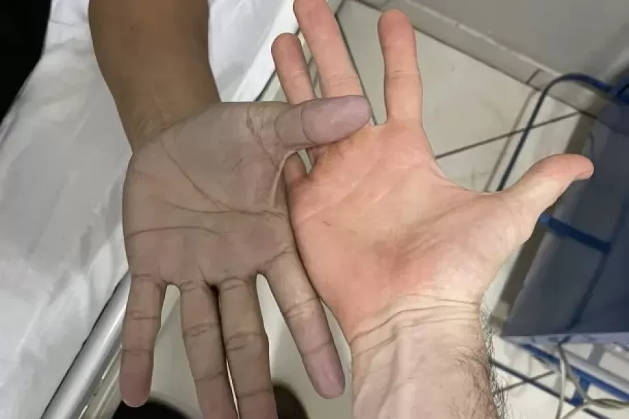 Un médico atendió a un joven con las manos azules y el diagnóstico sorprendió a todos