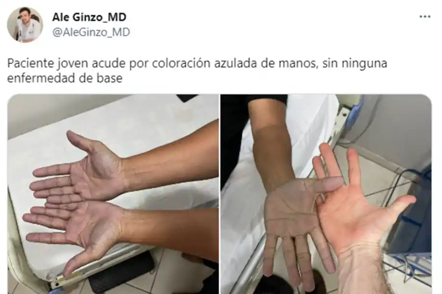 Un médico atendió a un joven con las manos azules y el diagnóstico sorprendió a todos