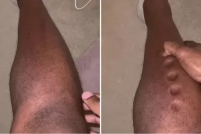 Un atleta mostró la patología que sufre y se hizo viral en TikTok: “piel de plastilina”