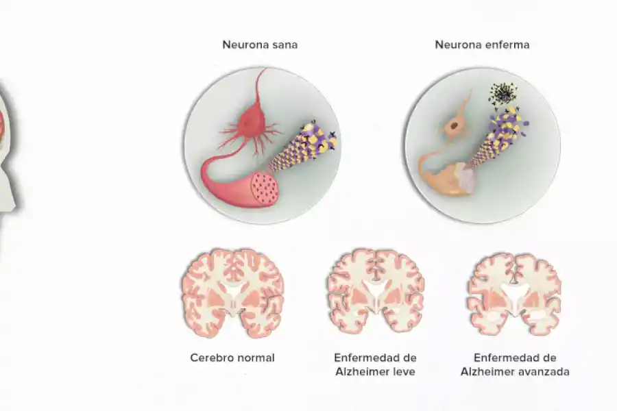 Alzheimer: investigan si la enfermedad se desarrolló en un joven de 19 años