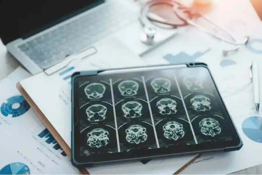 En el mundo están aumentando los casos de Alzheimer de inicio precoz (antes de los 65 años). Pero el caso del joven en China sería infrecuente/ (Getty)