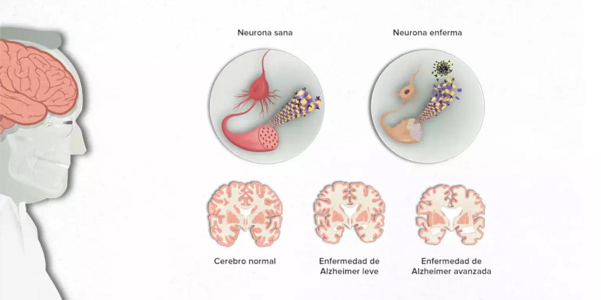 Alzheimer: investigan si la enfermedad se desarrolló en un joven de 19 años