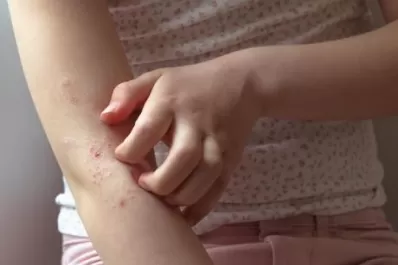 Vuelta al aula: la dermatits atópica afecta la concentración de los niños en el aula
