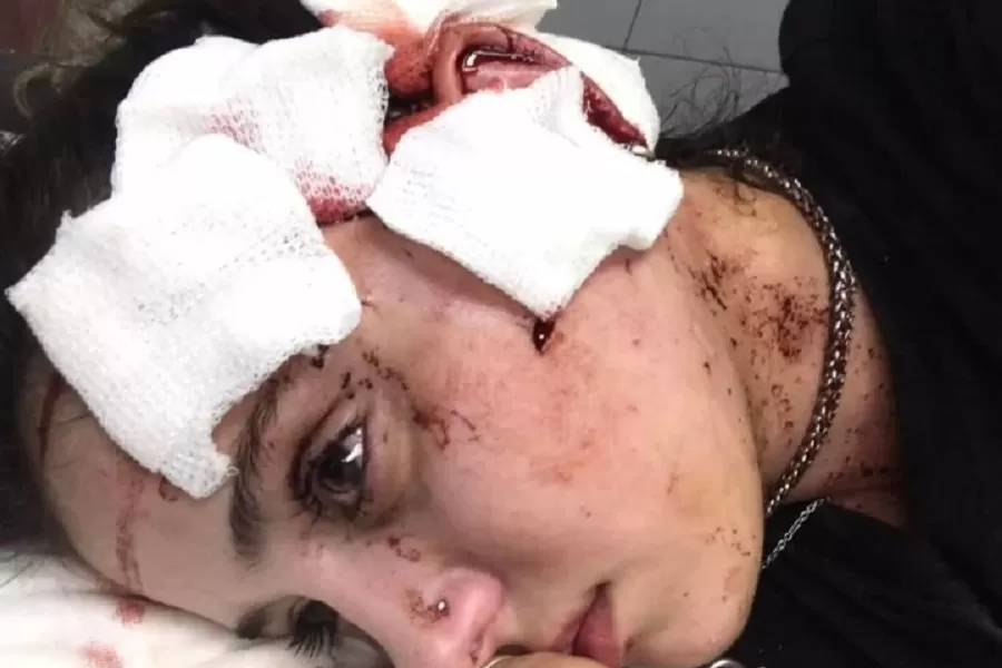 Me arruinaron la cara: una moza fue agredida por dos clientes en Mendoza