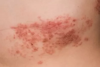 Ya está disponible en el país una nueva vacuna contra el Herpes Zóster