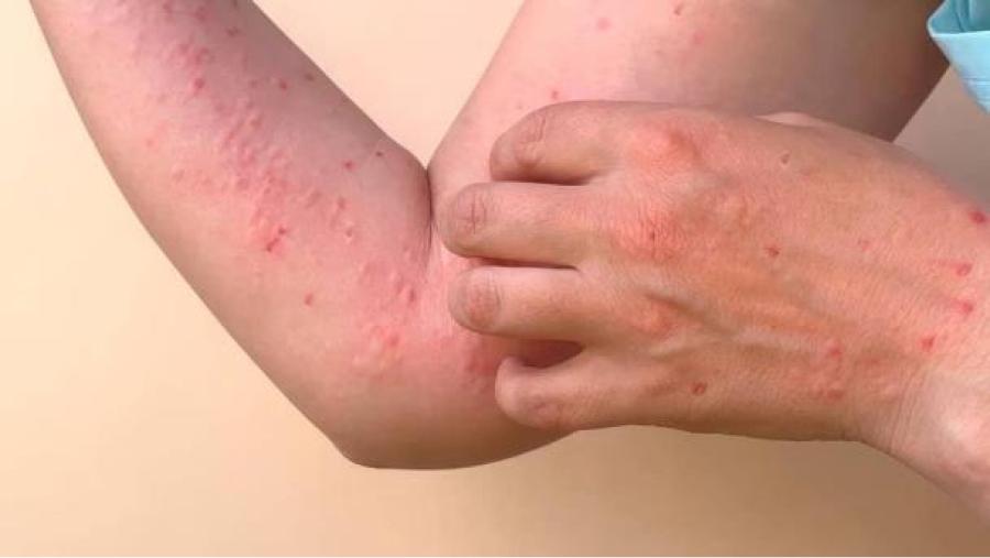 Sarpullido en la piel, uno de los síntomas que pueden presentar las personas infectadas con dengue.