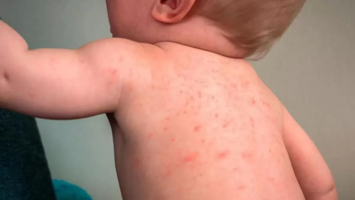 Cómo es el dengue en niños y bebés