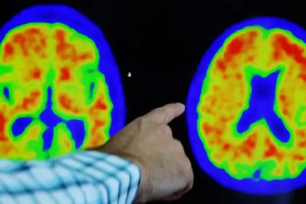 Un fármaco en estudio retrasa el avance del Alzheimer