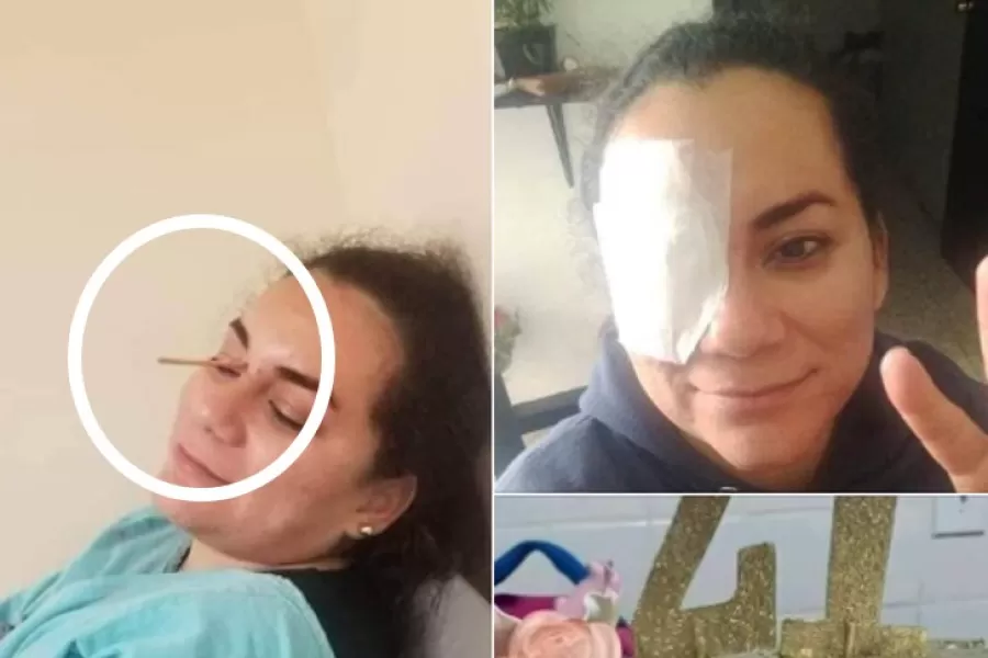 De la broma a la tragedia: una mujer casi pierde uno de sus ojos por el tradicional “tortazo” en su fiesta de cumpleaños