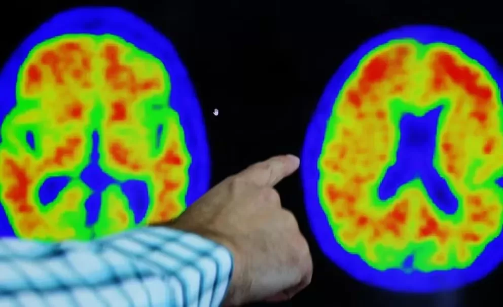 HUELLAS. Un médico muestra evidencias de Alzheimer en una imagen en el hospital de Boston. 