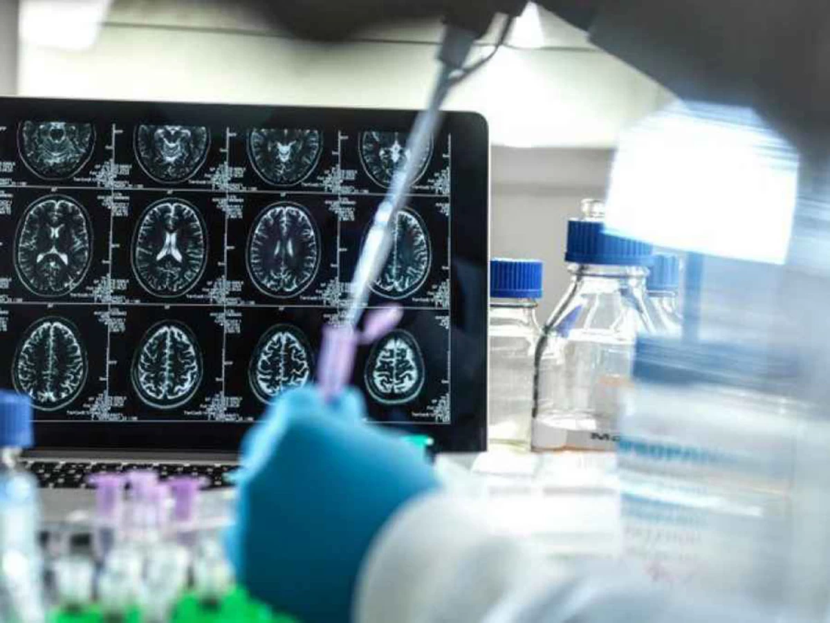 Alzheimer: con Inteligencia Artificial identifican genes y aceleran el desarrollo de medicamentos