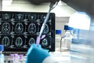 Alzheimer: con Inteligencia Artificial identifican genes y aceleran el desarrollo de medicamentos