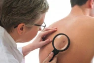 Expertos dan cinco consejos para prevenir el cáncer de piel