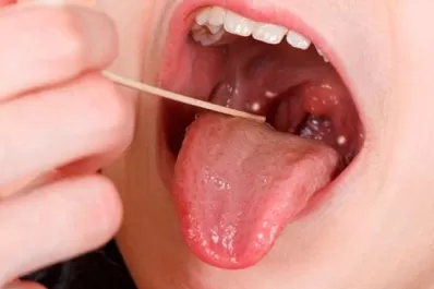 Por estas razones, el Streptococcus pyogenes a veces se vuelve mortal