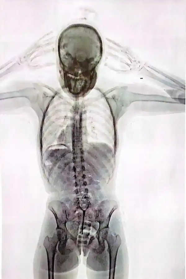 La impactante imagen de una “mula” detenida en Ezeiza con 78 cápsulas de cocaína en el cuerpo