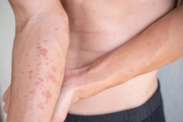 Dermatitis atópica: afecta a uno de cada cinco niños