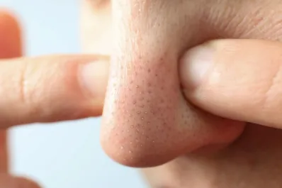 Puntos negros en la nariz: cuáles son los mejores trucos para eliminarlos