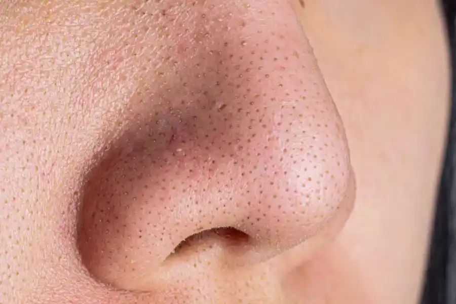 Puntos negros: trucos y consejos para eliminarlos de la nariz