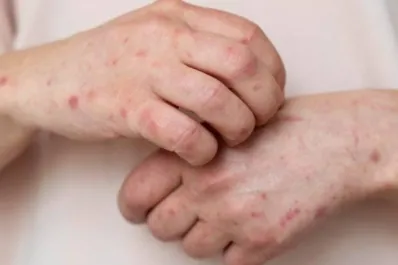 Herpes zóster o culebrilla: qué es, cómo se contagia y cómo tratarla