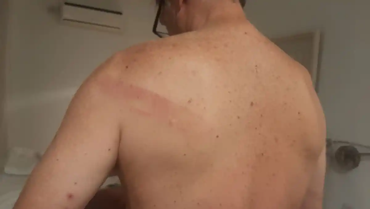 MARCAS. Uno de los bikers muestra la lesión.