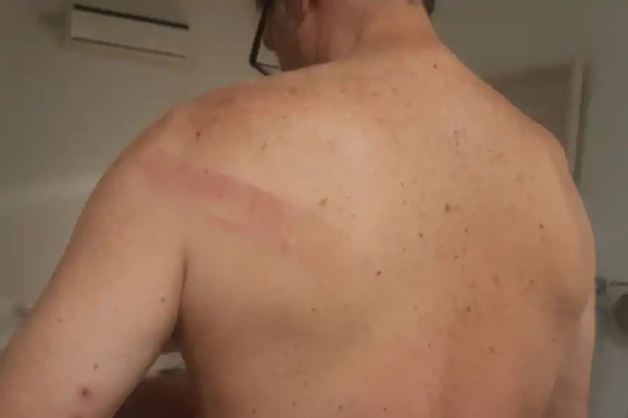 MARCAS. Uno de los bikers muestra la lesión.