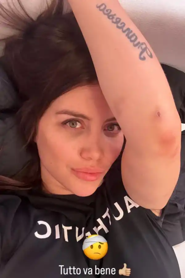 Las fotos de Wanda Nara con moretones que causaron preocupación