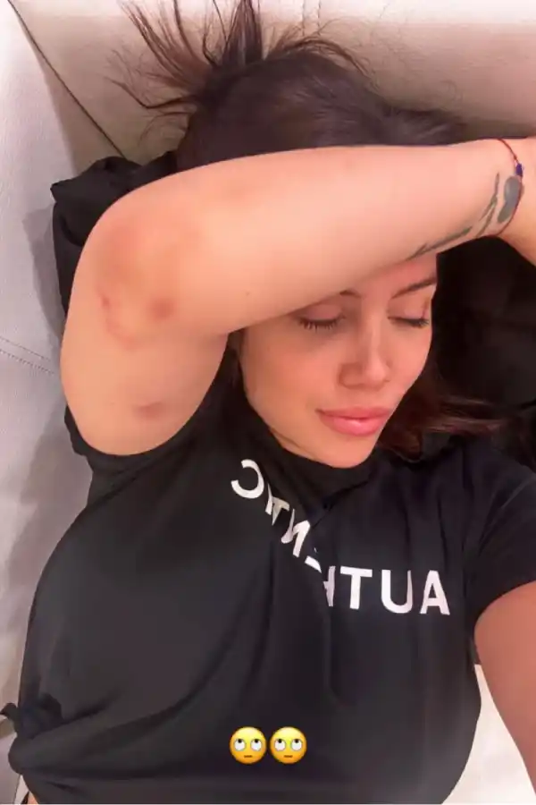Las fotos de Wanda Nara con moretones que causaron preocupación