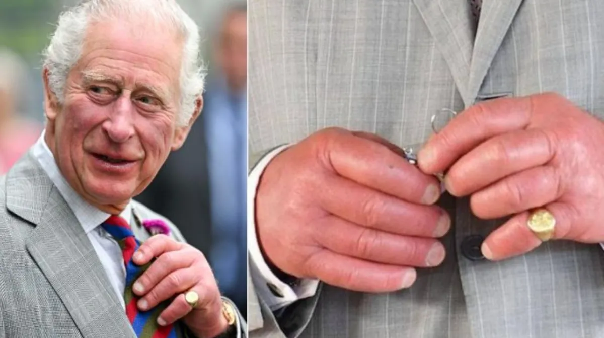 El rey Carlos habló sobre sus “dedos de salchicha”: ¿por qué los tiene así?