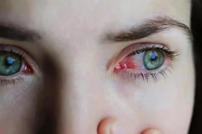 Llega la época de conjuntivitis: qué hacer para prevenirla