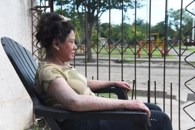 Cremas, cuidados y la mirada ajena: cómo es vivir con ictiosis lamelar