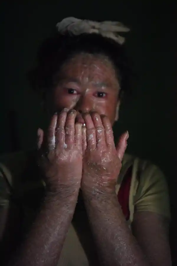 CON CUIDADO. Para no lastimarse la piel, Eliana debe tener muchas precauciones. Si sale, debe usar guantes.  LA GACETA / FOTO DE ANALIA JARAMILLO